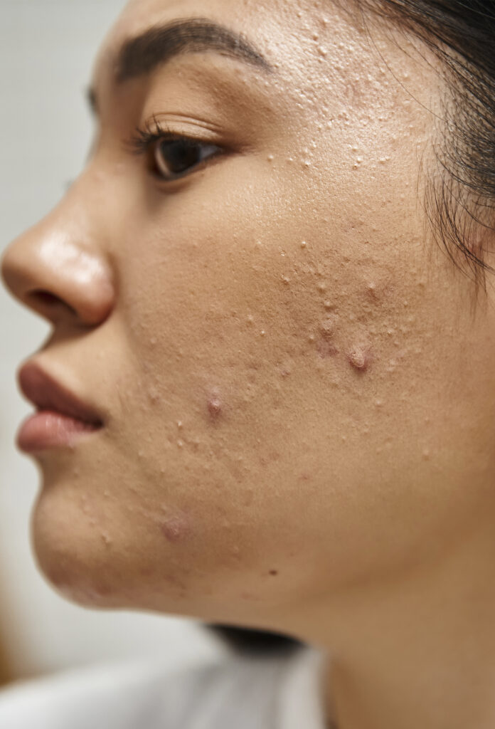 Acné - Une peau nette et apaisée à Verlinghem, près de Lille